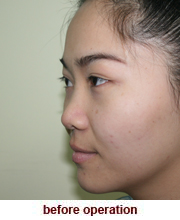 plastic_surgery_augmentation_rhinoplasty